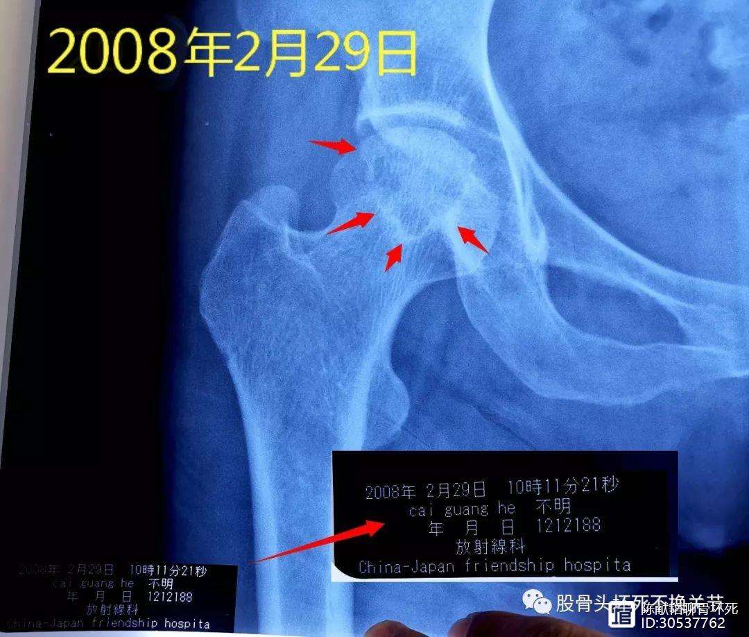 荆州人工骨头医保报销多少(人工骨头医保报销多少比例)