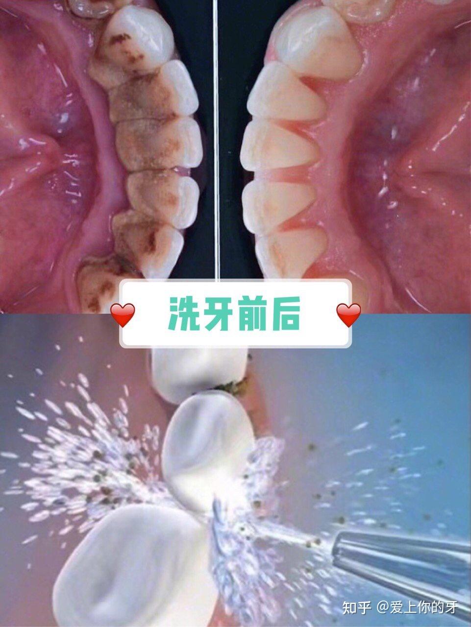 荆州洗牙可以用医保吗(洗牙可以用医保吗,报销比例多少)